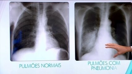 Pneumonia pode ser identificada através de um raio-x Pneumonia pode ser identificada através de um raio-x