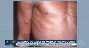 Em meio a aumento de casos, estado de SP avalia compra de vacinas contra varíola dos macacos | São Paulo