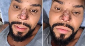Naldo Benny sofre princípio de necrose no nariz após procedimento estético