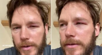 Chris Pratt mostra rosto inchado após ser picado por abelha